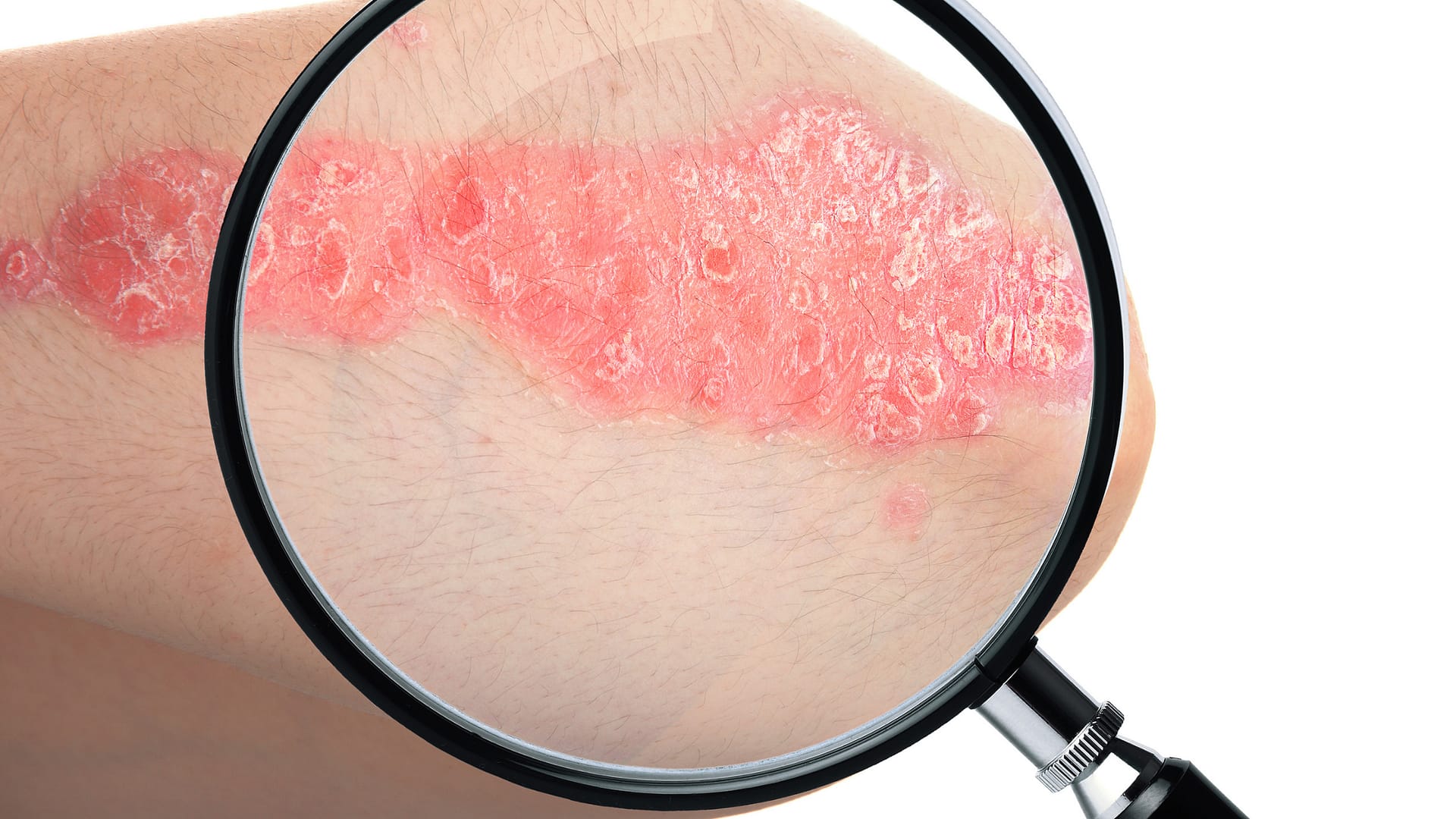 CBD egyéb bőrproblémák eseténű